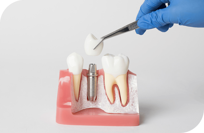 발치즉시 임플란트