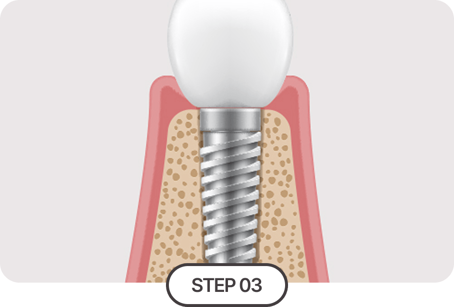 보철물 식립(크라운)
