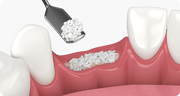 뼈이식 임플란트