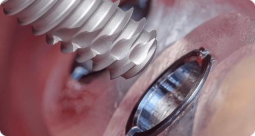 임플란트 재수술