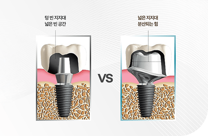 맞춤형 지지대 사용으로 심미성과 기능성의 완성