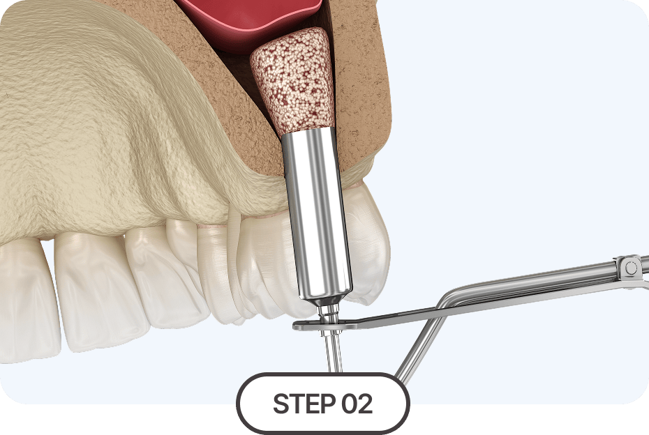 상악동 거상술 시행
