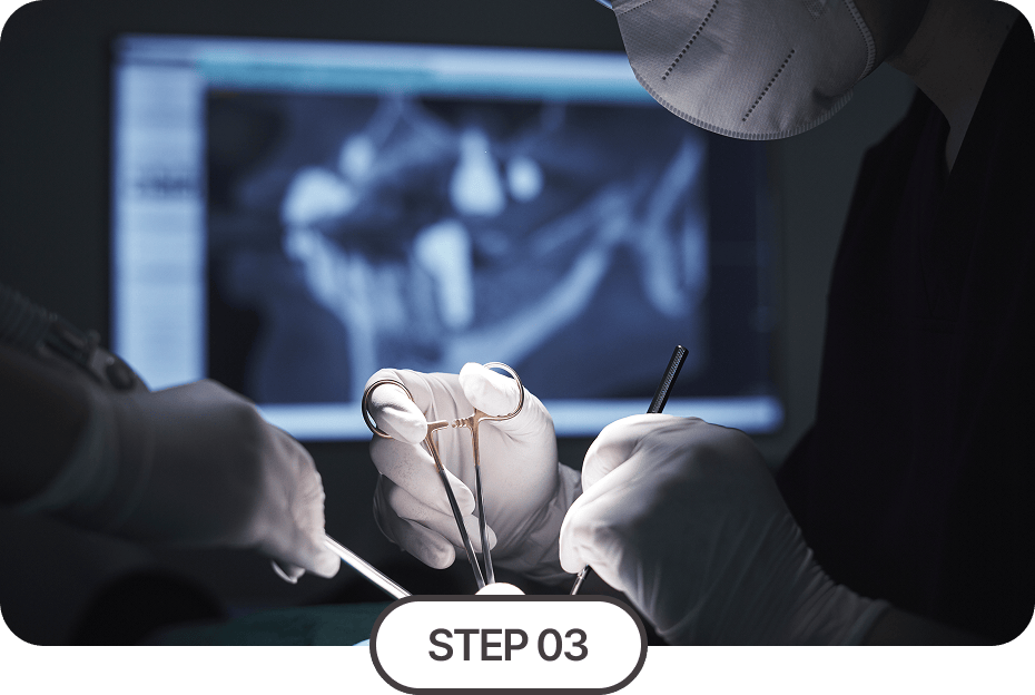 임플란트 식립 및 보철물 결합