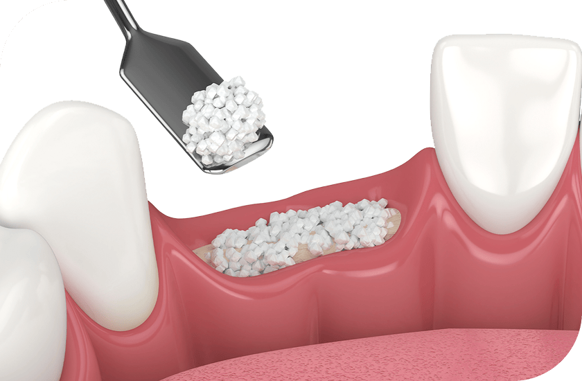 뼈이식 임플란트