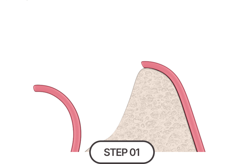 잇몸 뼈 소실 정도 진단
