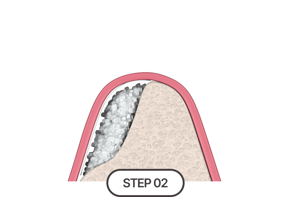 식립 할 위치에 인공뼈 이식