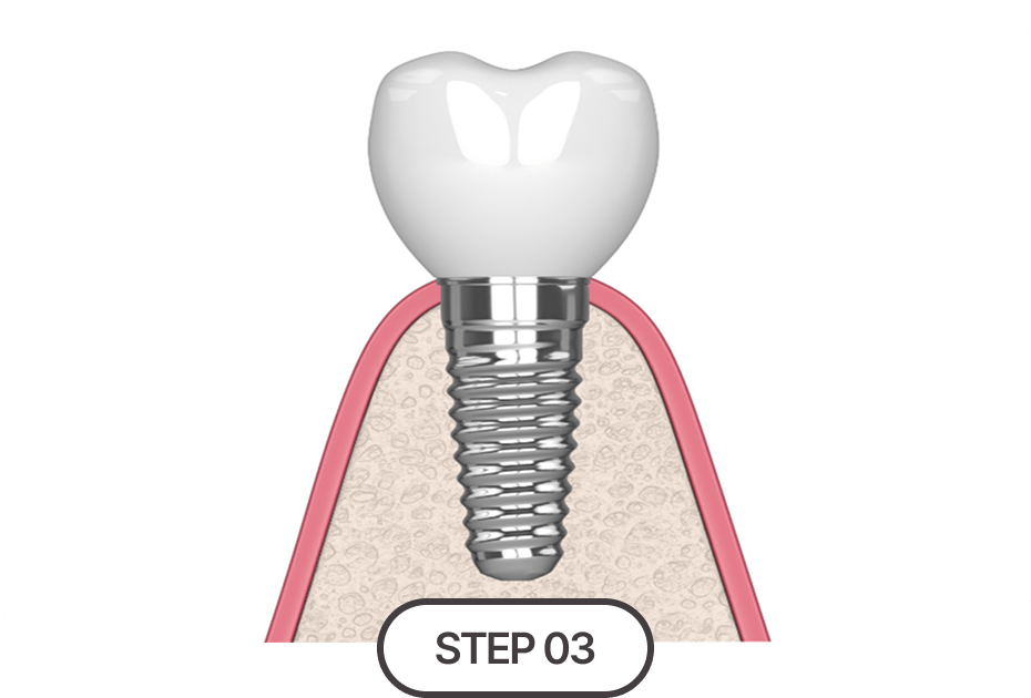 임플란트 식립 및 보철물 결합