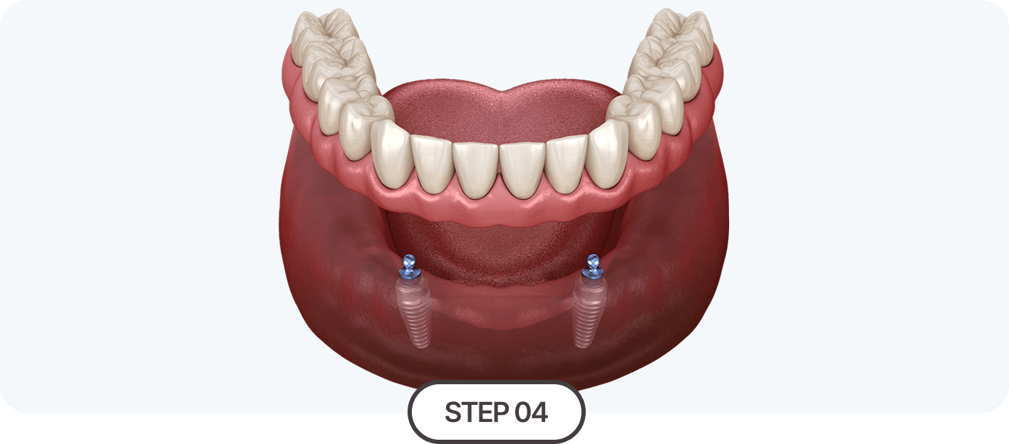 임플란트 틀니 고정