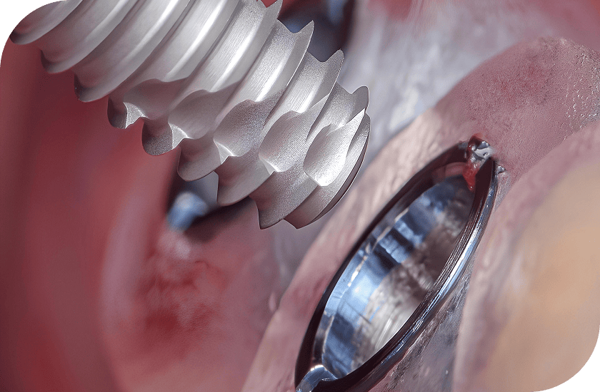 임플란트 재수술