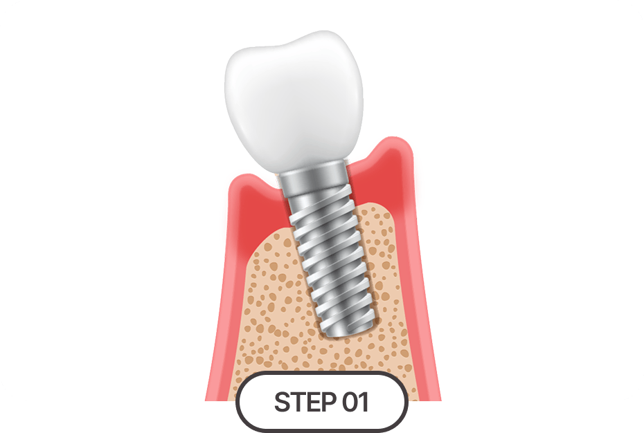 기존 임플란트 제거 및 염증 치료
