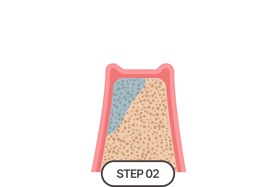 골 재건 및 식립 기반 형성
