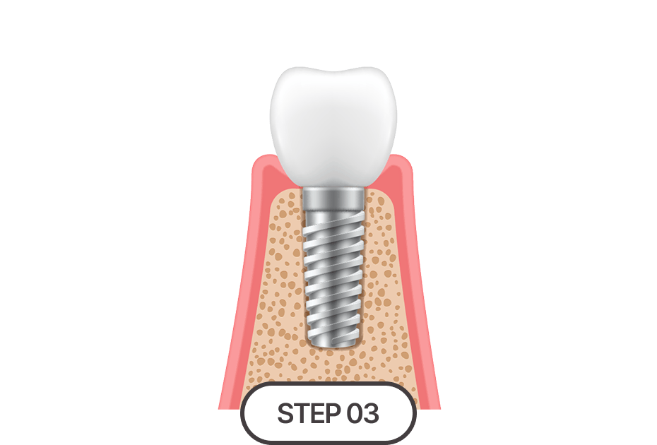 정밀 식립 및 보철 완성