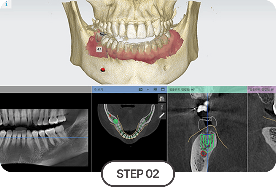 3D 디지털 모의수술