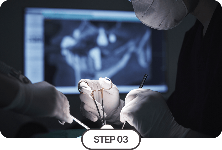 임플란트 식립 및 보철물 결합