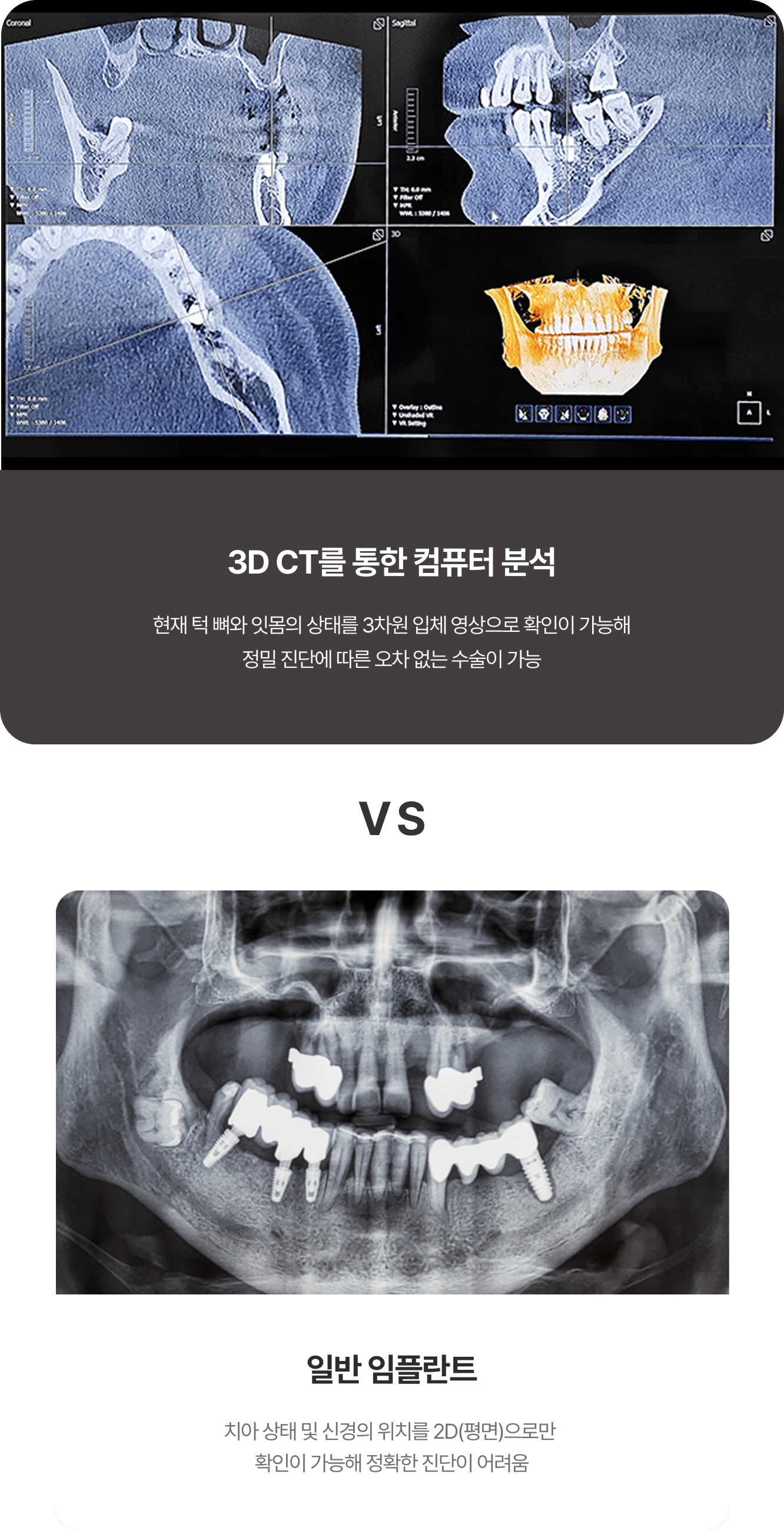 치아 상태 및 신경의 위치를 2D(평면)으로만 확인이 가능해 정확한 진단이 어려운 일반 임플란트와 현재 턱 뼈와 잇몸의 상태를 3차원 입체 영상으로 확인이 가능해 정밀 진단에 따른 오차 없는 수술이 가능한 네비게이션 임플란트